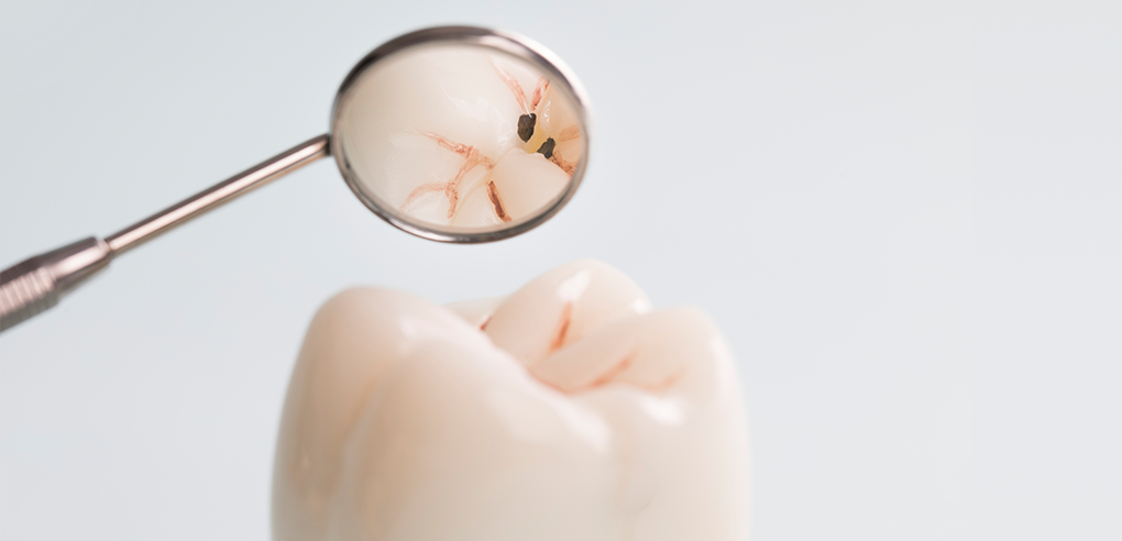 Dr. SONG DENTAL CLINIC|충치치료
